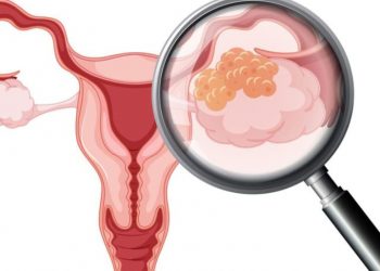Vulva kanseri (dış genital bölge kanserleri)