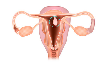 Sarkom (uterin sarkomlar)