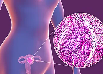 Rahim kanseri (endometrium kanseri)