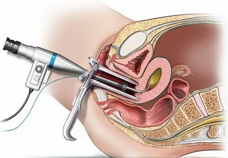 Kamera ile rahim içi operasyonlar (Histeroskopi)
