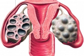 Rahim duvar kalınlaşması (endometrial hiperplazi /EİN)